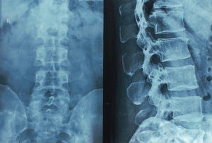 x-ray of spinal cord injury